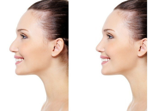 Imagen 1 de 4 de Corrector Nariz Bonita Pretty Nose Original Oferta ! S/24,90
