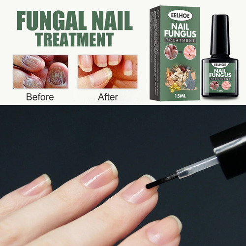 Alivia Uñas Enterradas Elimina Onicomicosis Nail Fungus