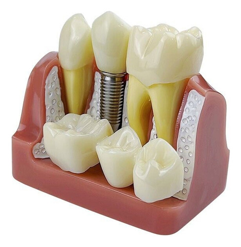 Modelo De Dientes De Implante Dental De 4 Tiempos