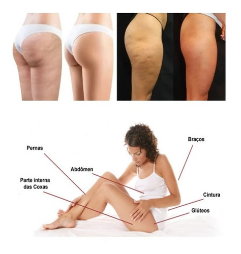 Imagem 2 de 5 de Drenagem Anti Linfática Celluless Massageador Aparelho