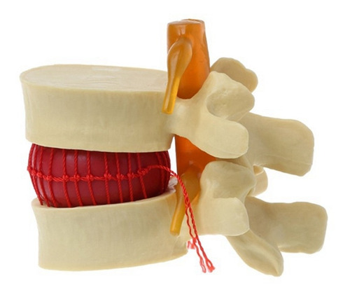 Modelo De Vértebras Lumbares: Columna Anatómica, Hernia De D