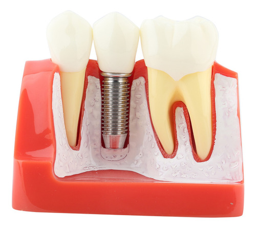 Análise De Implante De Modelo Dentário De Demonstração Dentá