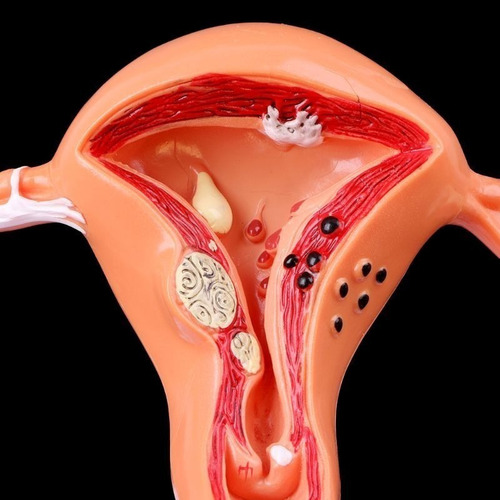 Modelo Anatómico De Ovario Uterino Con Patologías