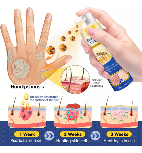 Spray For El Cuidado De La Psoriasis Furzero Psoriaheal Con