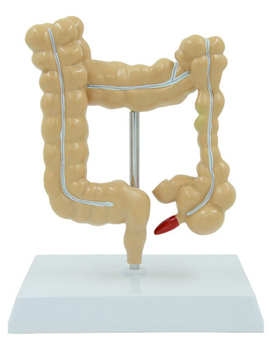 Simulación Didáctica De Un Modelo De Patología De Colon