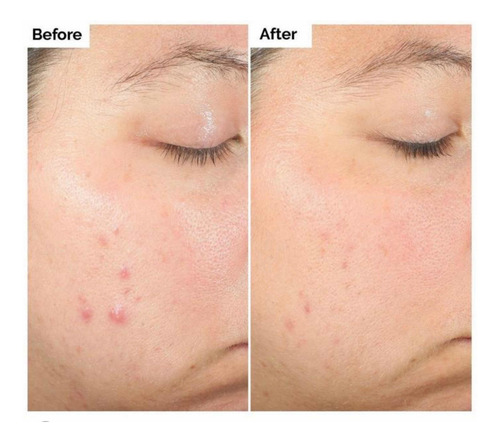 The Ordinary Salicylic Acid 2% Solution (30 Ml, Original)