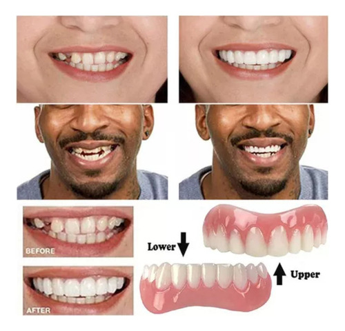 Carillas Superiores E Inferiores De Silicona Para Dientes Pe