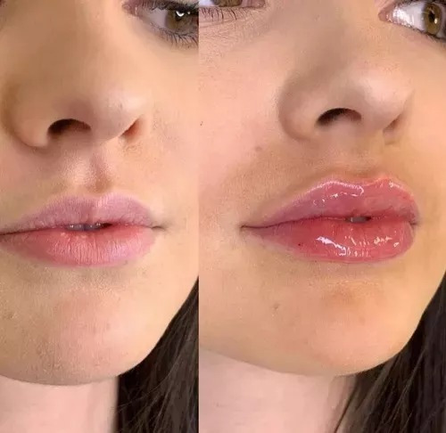 Engrosador De Labios Lip Plumping Balm C/acido Hialuronico