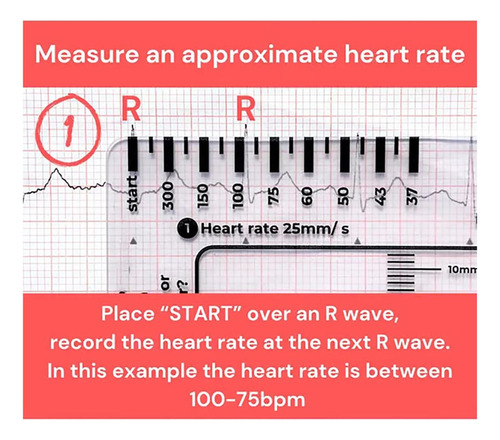Regla De Electrocardiograma De 7 Pasos, Regla De Electrocard