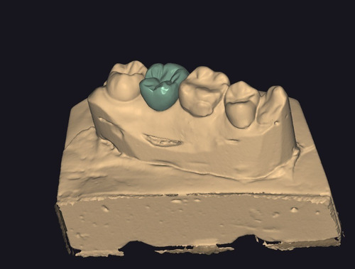 Escaneos E Impresión 3d Odontologia Dental Scan