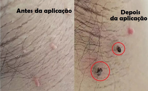 Tca Ata 100% 2,5ml - Ácido Tricloroacético Tipo De Pele Todo Tipo De Pele