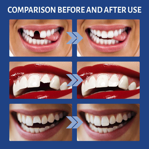 Pegamento Dental Temporal Multifuncional Para Rellenar Cavid