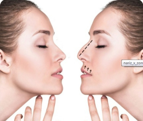 Nariz Bonita Respingada 8tamaños Original Corrector Nasal A1