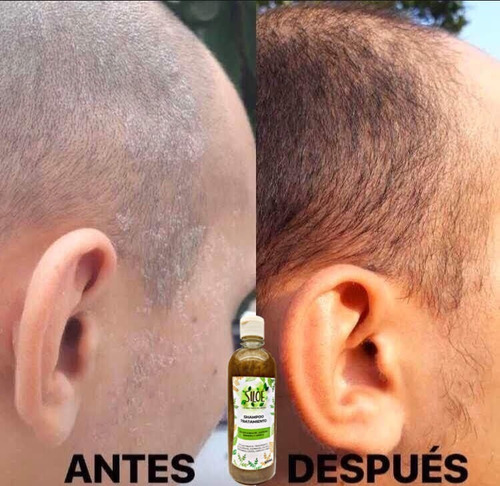 Pack De 3 Shampoos Siloe Contra Calvicie, Caspa, Alopecia.