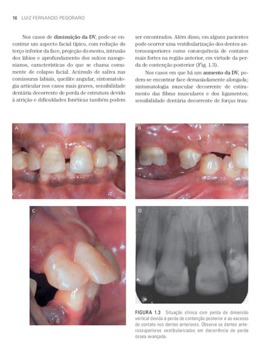 Prótese Fixa: Bases para o Planejamento em Reabilitação Oral, de Pegoraro, Luiz Fernando. Editorial Editora Artes MÉDicas Ltda., capa dura em português, 2013