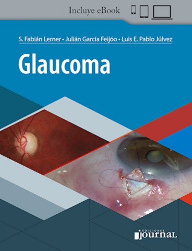 Glaucoma. Incluye E-book  Garcia Feijoo-lerner