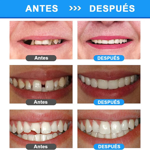 Set Dientes Postizos Temporal Falsos Reparación Dental