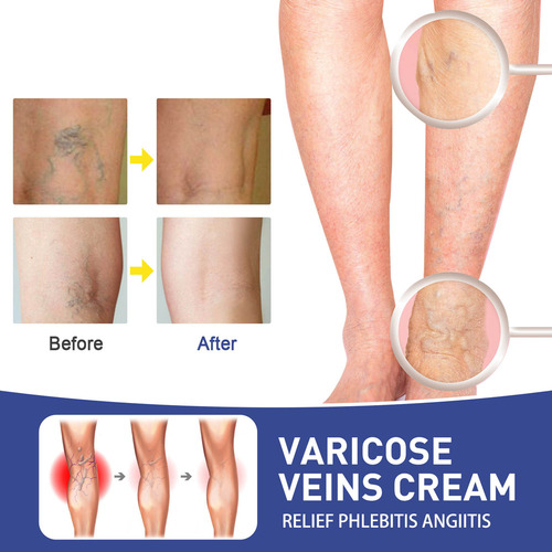 / R Parche Para Venas Varicosas Parche Para Venas Varicosas