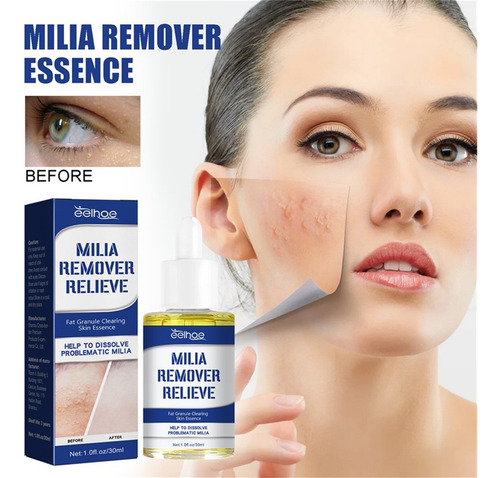 Milia Remover Eye Sebaceous Hyperplasia 30ml