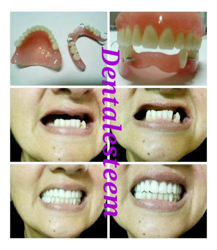 Imagen 5 de 5 de Prótesis Dentales Dentista Placas De Contencion Y Bruxismo