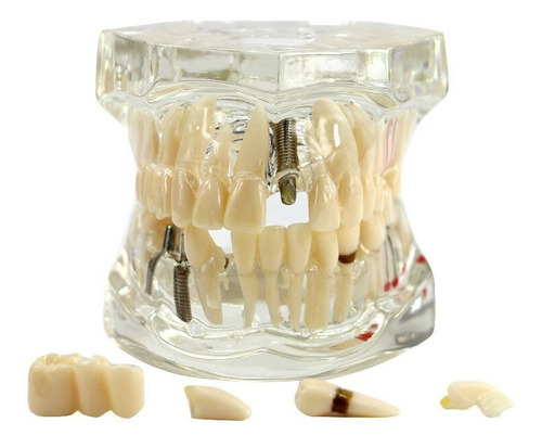 Maqueta De Enfermedades Dentales Salud Oral Odontologia