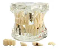 Comprar Maqueta De Enfermedades Dentales Salud Oral Odontologia