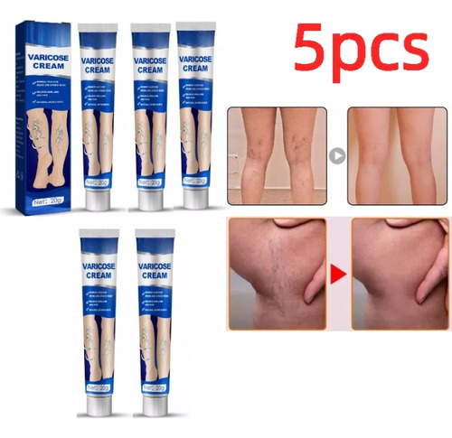 Crema Reparadora De Venas, 5 Unidades, Alivia Las Varices De