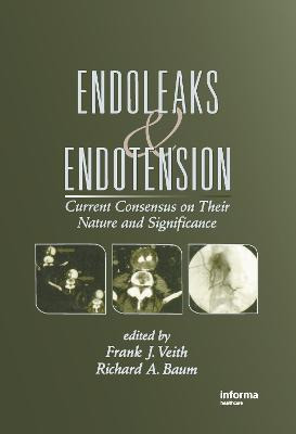 Libro Endoleaks And Endotension : Current Consensus On Th...