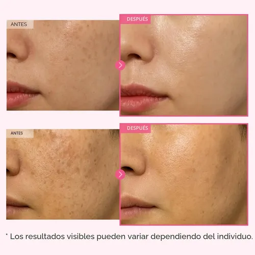 glutathione antes y despus Glutatin Simildiet: un aliado estratgico en tus protocolos estticos. Apoya los tratamientos Tosowoong Arbutin 7% Glutathione Crema,