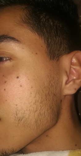 Minoxidil 60 Ml