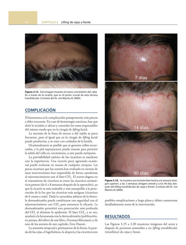 Procedimientos En Dermatología Cosmética.lifting Quirúrgico.