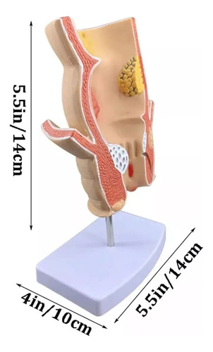 Yi Modelo Recto Patológico Humano, Modelo Recto Dañado
