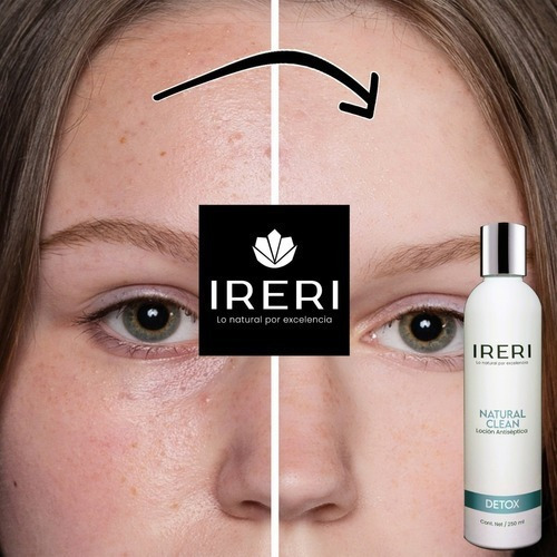 Imagen 8 de 9 de Loción Facial Antiséptica Limpieza Exfoliante Natural Piel Mixta A Normal Con Tendencia A Acné Seborrea Granos Espinillas Barros Línea Detox Natural Clean Ireri ®