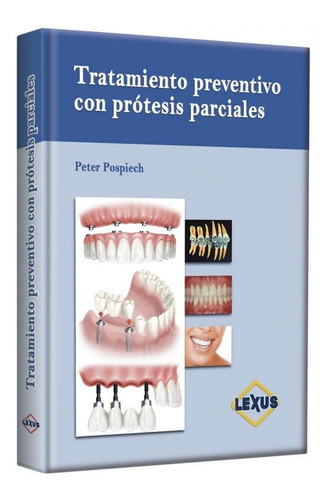 Tratamiento Preventivo Con Protesis Parciales - Lexus
