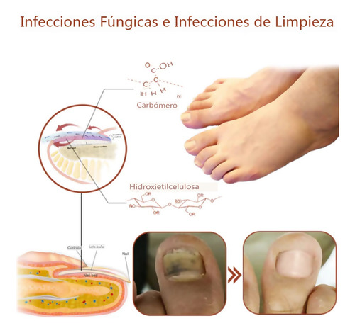 2×dispositivo Láser Limpieza Uñas Para Onicomicosis A