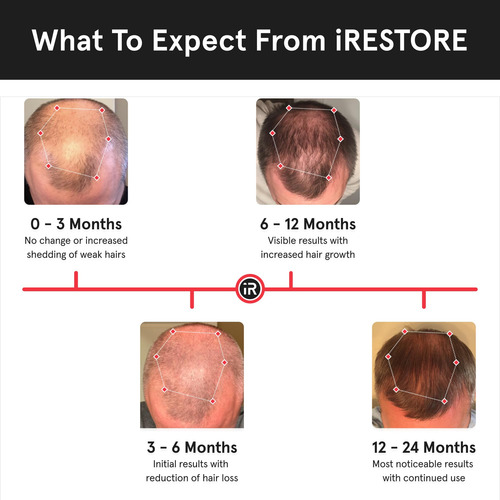 Sistema De Crescimento Capilar A Laser Irestore Professional