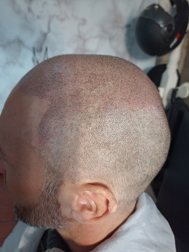 Imagen 2 de 5 de Micropigmentación Capilar Vzmicropigmentacion