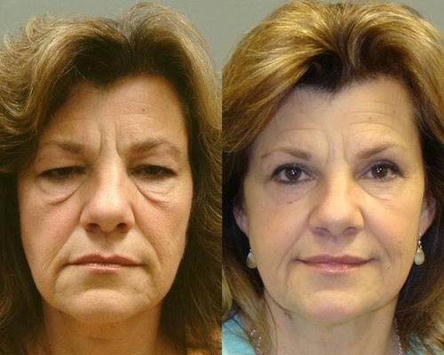 Skindulgence Rejuvenecimiento Facial Sin Cirugía 30 Min Tipo De Piel Todo Tipo De Piel
