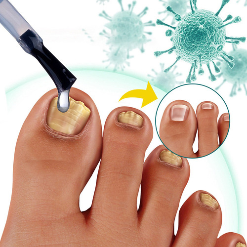 7×reparación La Decoloración Las Uñas Onicomicosis Soft