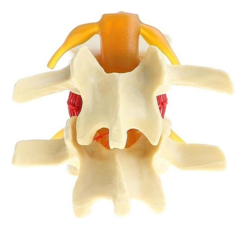 . 2x Modelo De Hernia De Disco Lumbar De La Columna
