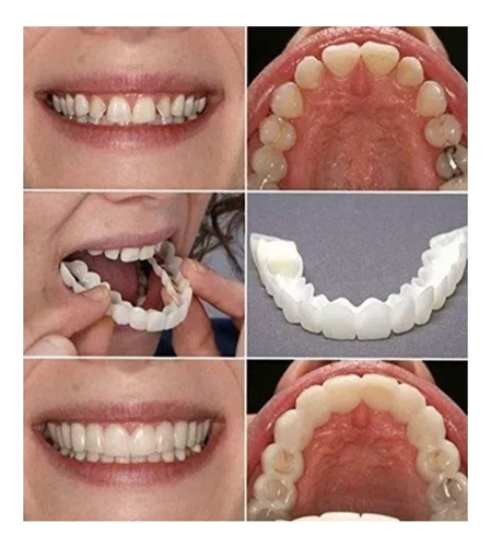 Prótesis Dentadura Postizo Snap On Smile Superior E Inferior