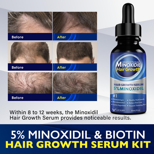 Solución De Crecimiento Del Cabello Con Minoxidil Al 5% Para