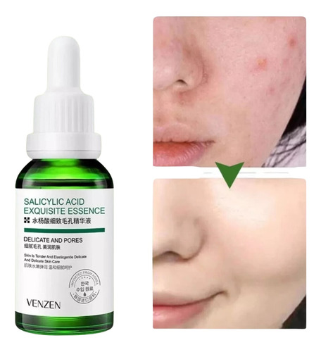 Sérum Facial Reductor Poros Ácido Salicílico Anti Acné