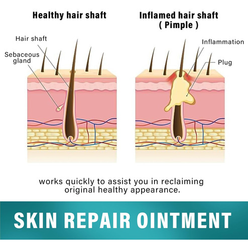 Dijkoo Crema De Foliculitis, Tratamiento De Foliculitis Para