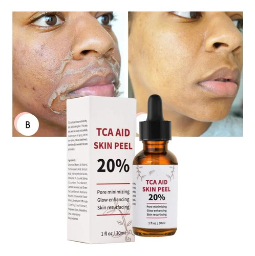 Tca, 30 Ml, Tricloroacético, 20%, Exfoliante Para La Piel, P