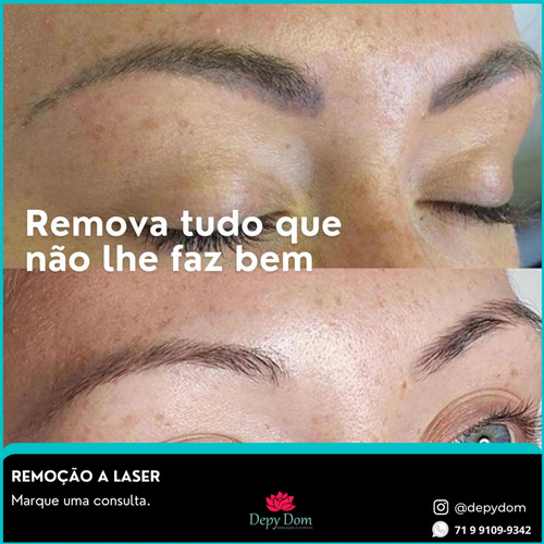 Imagem 2 de 2 de Remoção A Laser De Tatuagem E Micropigmentação