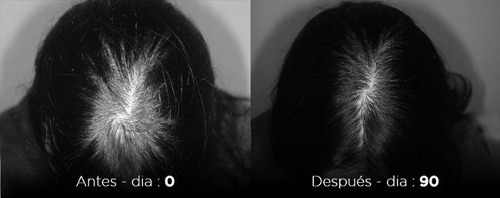 Imagen 4 de 10 de Idraet Locion Caida Cabello Genetic Hair Loss Control Out