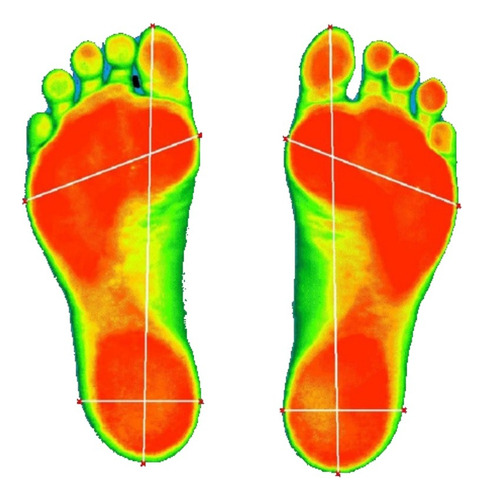 Pedigrafía Computarizada Arco Scan + Plantillas Ortopédicas