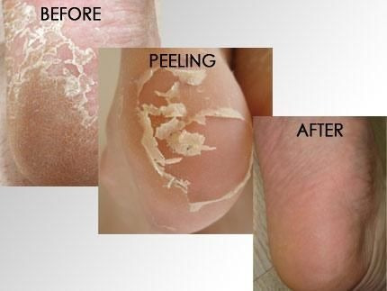 Mascarilla Exfoliante Para Pies, Chamos Acaci