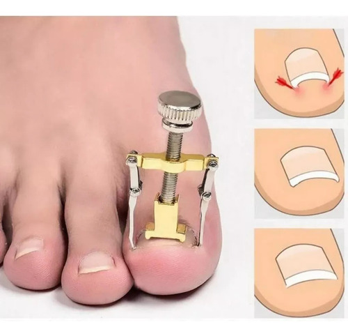 Grampo Corretor Unha Encravada Ferramenta Pedicure Dourado